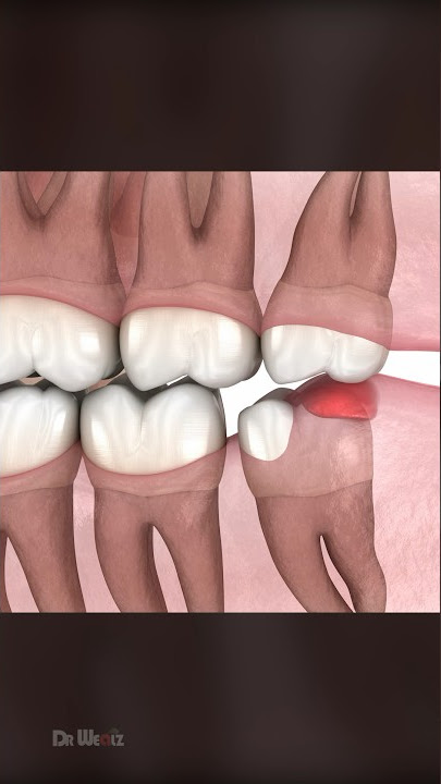 Should You Remove Wisdom Teeth?