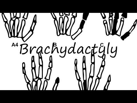 ቪዲዮ: እንዴት brachydactyly ማስተካከል ይቻላል?