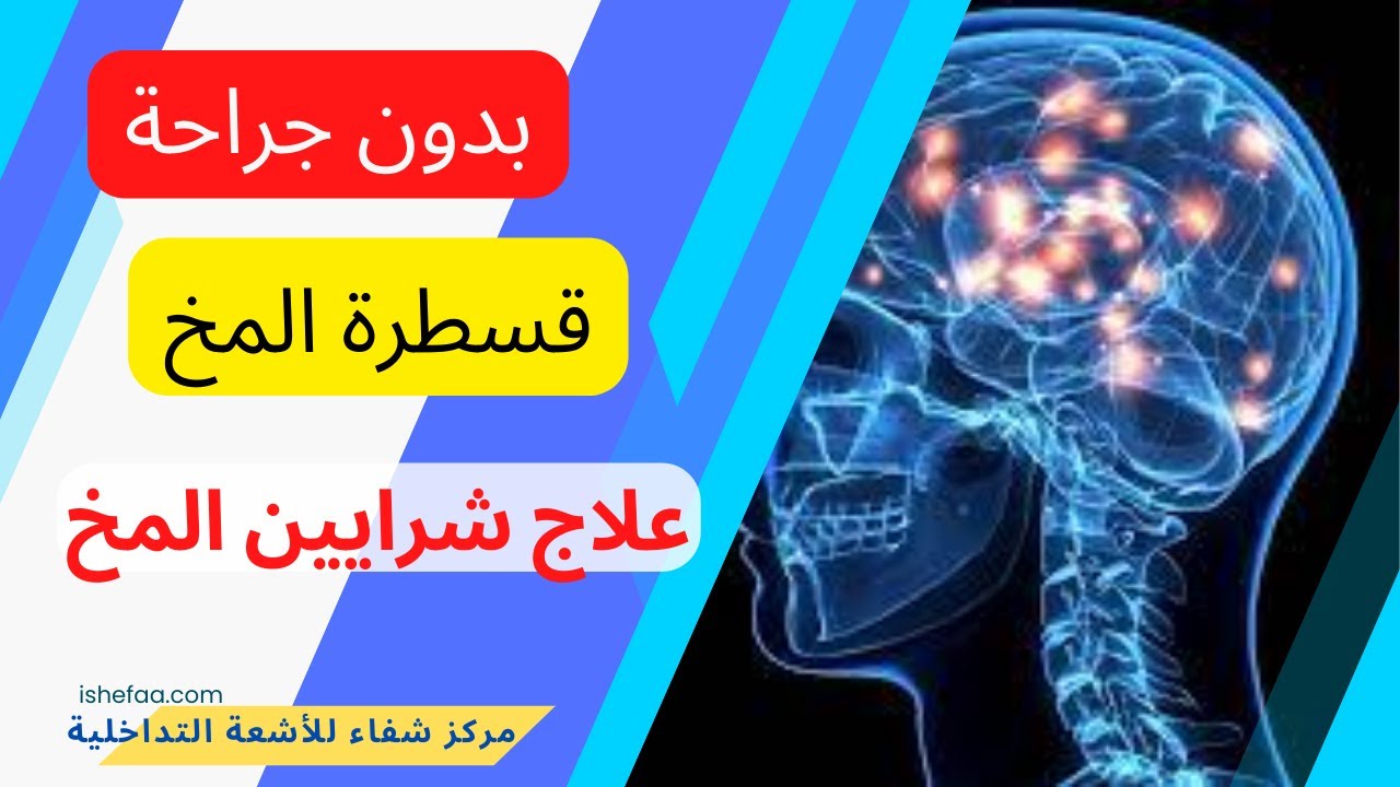 تمدد الأوعية الد موية في الدماغ و دور قسطرة المخ التشخيصية و العلاجية