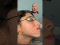 Laser Treatment of Red Marks Associated with Acne