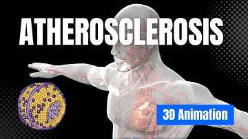 Learn about Atherosclerosis - 3D Animation