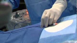 Cardiac Ablation - HealthBreak - Centennial Medical Center