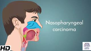 Nasopharyngeal carcinoma, Causes, Signs and Symptoms, Diagnosis and Treatment.