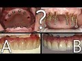 Which Would You Choose - A or B? | Full Mouth Prosthesis