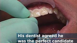 Michael: A Lumineers Veneers Case Study - 30-Second Dentistry™