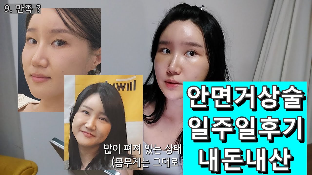 안면거상 수술 일주일 후기 QnA (내돈내산)