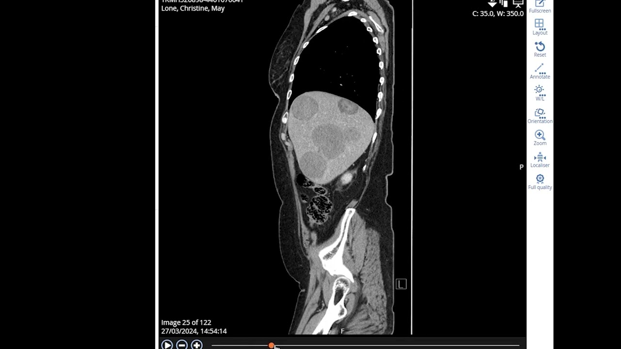 mum march ct scan2023