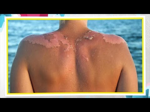 Video: ¿La piel quemada por el sol irradia calor?