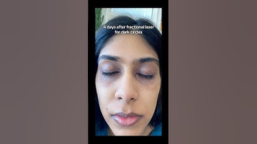 Laser for dark circles #darkcircles #darkcirclestreatment