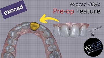 exocad Q&A: Pre-Op Feature