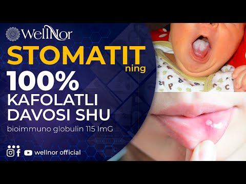 Video: Antibiotik stomatit: mumkin bo'lgan sabablar va davolash