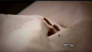 Treating America's Bedbug Problem