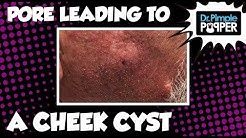A Pore Leading into a Cheek Cyst