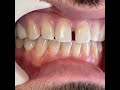 Check out this amazing transformation, we placed 28 porcelain #veneers for our young male patien