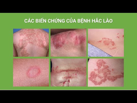 Các Biến Chứng Của Bệnh Hắc Lào (Nấm Da) | Bác sĩ Tân | Full HD