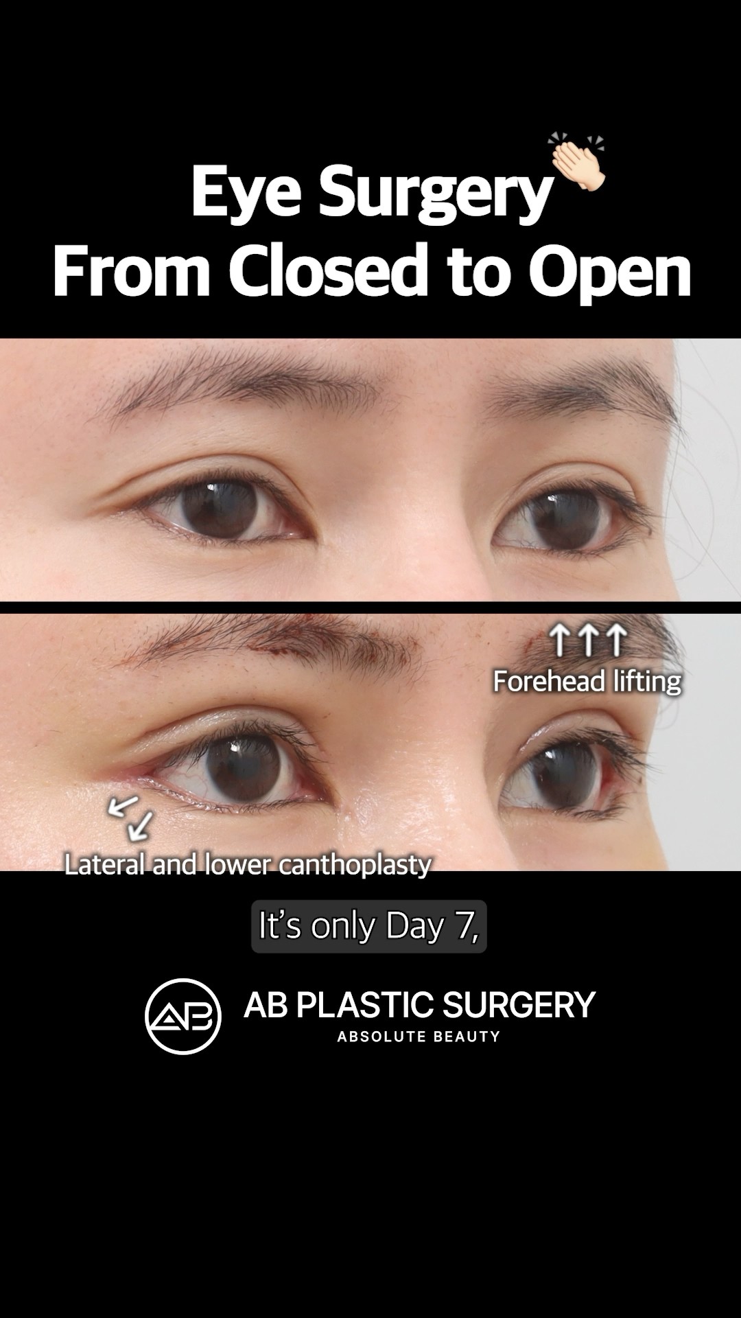 Korean Eye Surgery Made Her Eyes Huge #shorts