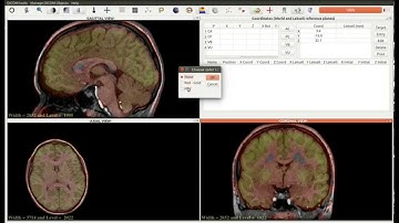 Multimodal registration (PET-scan and MRI) in JimboDICOMViewer