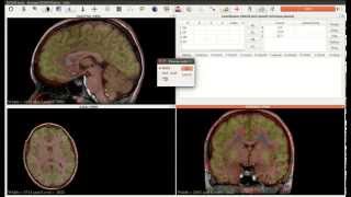 Multimodal registration (PET-scan and MRI) in JimboDICOMViewer