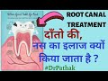 ROOT CANAL Treatment kya hai? RCT of tooth | dant ki naso ka ilaj, Dental decay, Pain Dr Pathak