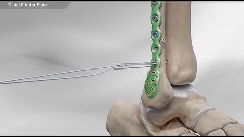 Distal Fibular Plate
