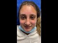 Septorhinoplasty/Sinus Surgery 12 days ago and looking good