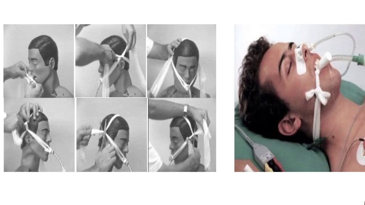 Sujetador Tubo Endotraqueal Medisol | atelier-yuwa.ciao.jp