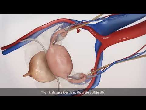 Video: Ce este salpingectomia bilaterală laparoscopică?