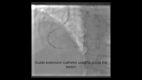 Guide extension catheter Guidezilla support PCI