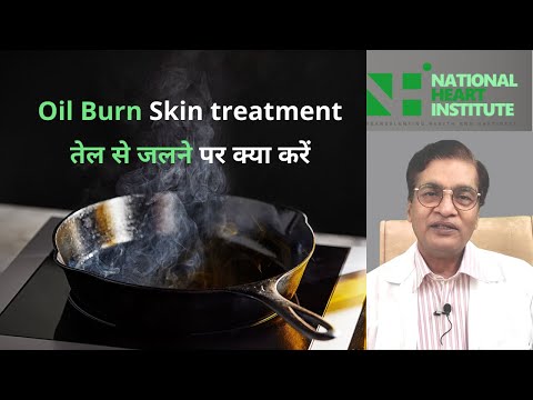 तेल से जलने पर क्या करें Oil Burn Skin Treatment Home Remedy | Dr. Karoon Agrawal