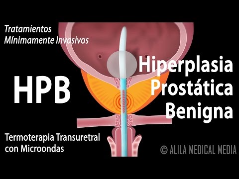 Vídeo: Alternativas A La Tamsulosina (Flomax): ¿Qué Más Trata La HPB?