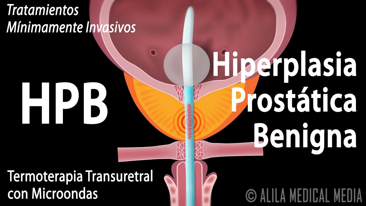 hipertrofia prostatica benigna icd 10)