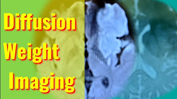 Diffusion Weight Imaging (DWI)