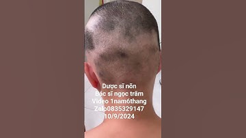 rụng tóc mảng. anh giang nguyễn. video 1nam6thang