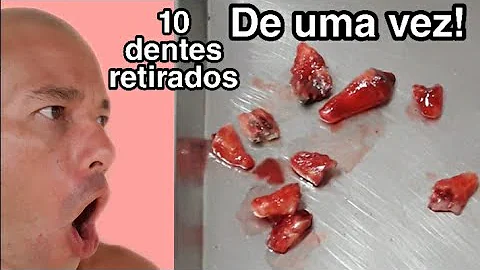 Quantos dentes podem ser extraídos de uma só vez?