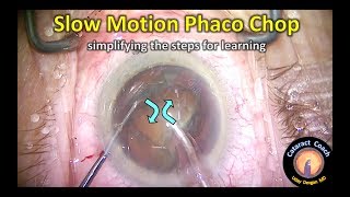 slow motion phaco chop cataract surgery