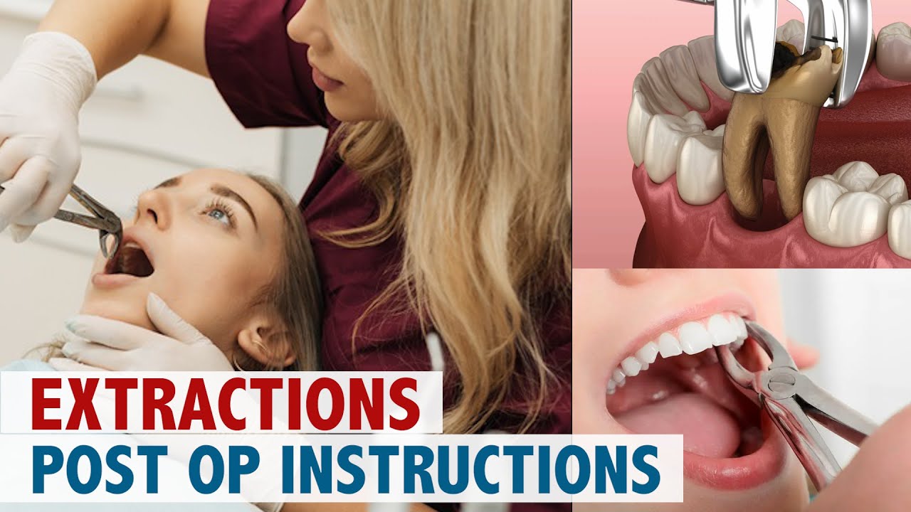 extractions-post-op-instructions-youtube