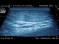 Back Mass Lipoma 2025 07 17 18 00 Back Mass Lipoma 2025 07 17 18 00