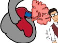 Fibrilación auricular e infartos cerebrales. Dr. Huge Stat!