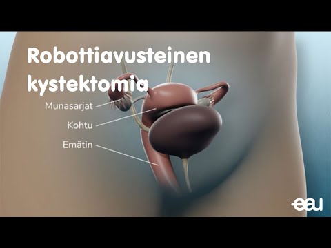 Video: Tulisiko virtsarakon syöpä näkyviin ultraäänitutkimuksessa?