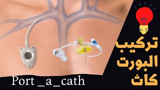 تركيب جهاز البورت كاث لحقن الكيماوي POrt -A-Cath