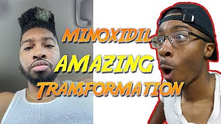 Celebrity 6 Month Minoxidil Beard, Before and After! (2021) Net Worth