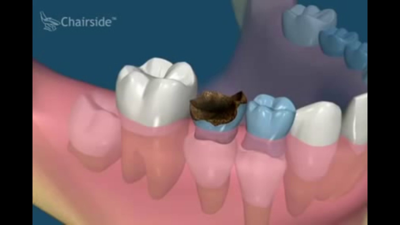 Как Выглядит Молочный Зуб Фото – Telegraph