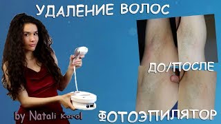 Удаление волос / Фотоэпилятор / Результат ДО и ПОСЛЕ 14 процедур - Видео от Natali Korol