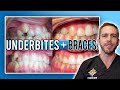 Underbite Braces Treatment [BEFORE & AFTER]