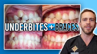 Underbite Braces Treatment [BEFORE & AFTER]