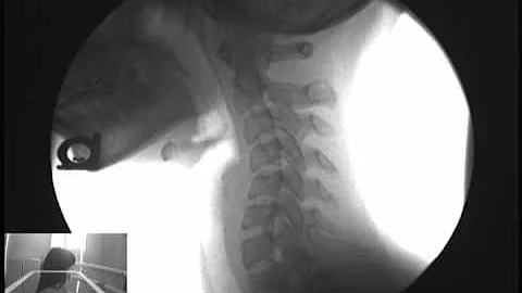Car Accident | Vancouver Washington| Neck Injury |...