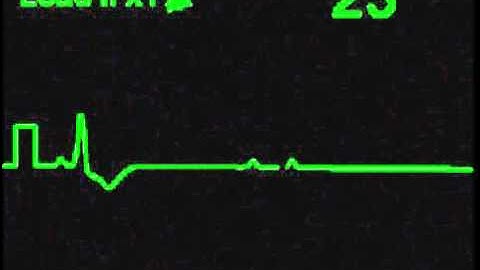 3rd Degree AV Block - ECG Simulator - Arrhythmia Simulator