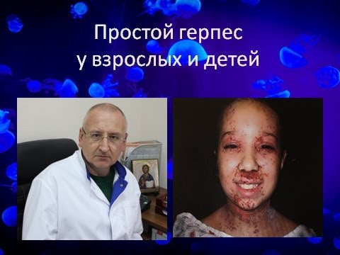 Герпес. Типы герпеса.  Герпес у взрослых. Герпес у детей. Герпес фото.