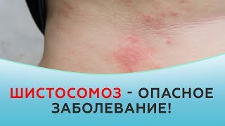 Шистосомоз  - опасная паразитарная болезнь!