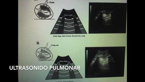 Ultrasonido Pulmonar